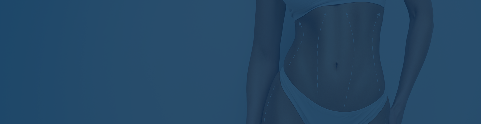 TUMMY TUCK (ABDOMINOPLASTY)